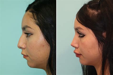 Lip Augmentation Photos Chevy Chase Md Patient