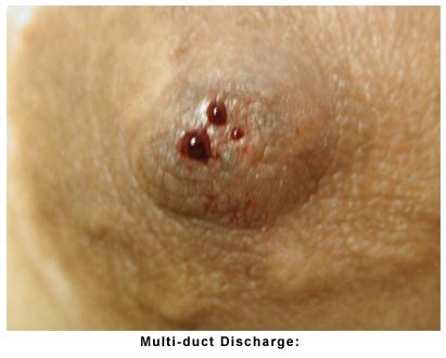 Ppt Nipple Discharge Causes Symptoms Daignosis Prevention And Hot Sex