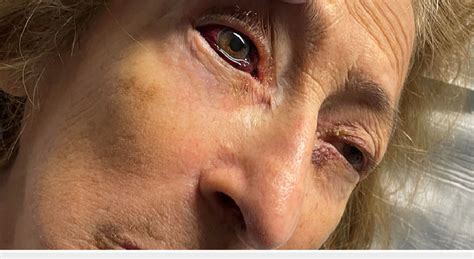 Hemorrhagic Chemosis Of The Right Eye Most Evident Inferiorly
