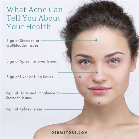 Face Mapping What Your Acne Is Telling You Face Mapping Face Acne Acne
