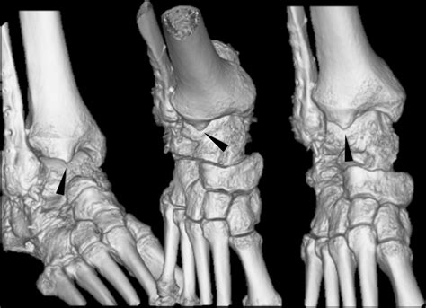 Anterior And Posterior Ankle Impingement Syndromes Foot And Ankle Clinics