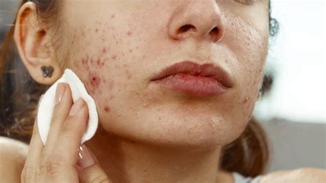 Step By Step Instructions To Choose The Right Type Of Acne Treatments