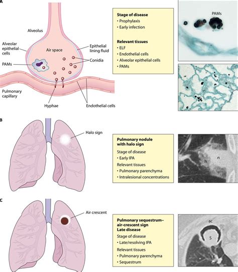 Different Stages Of Invasive Pulmonary Aspergillosis Ipa And The