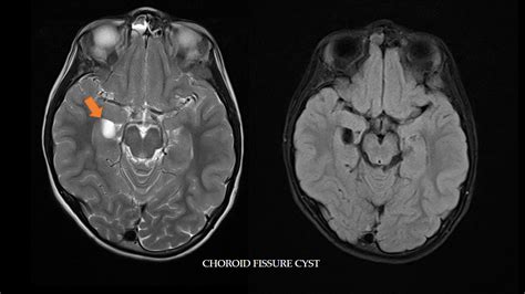 Simple Science: How to Make a Volcano with Kids