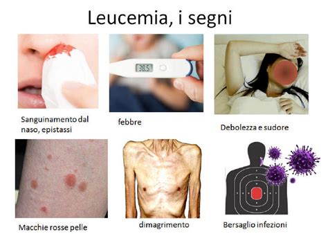 Jun 07, 2021 · nel caso del tennista luzzi, la leucemia fulminante era stata scambiata, in un primo momento, per polmonite. Leucemie acute e croniche, quali novita'?