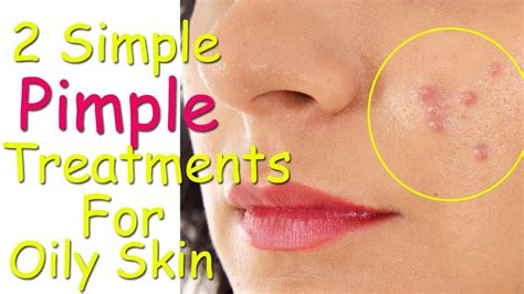 Two Simple Pimple Treatments For Oily Skin How To Remove Pimples Overnight Pimples Removal
