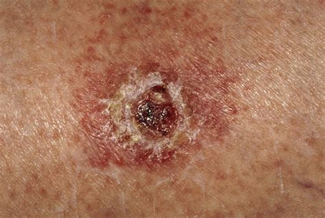 The 5 Types Of Skin Cancer You Need To Know How To Recognise Geelong