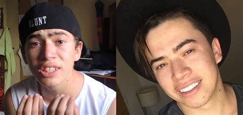 Após ser duramente criticado por uma legenda em foto de antes e depois, felipe neto resolveu brincar com o caso. Febre dos famosos: saiba tudo sobre faceta e lente de ...