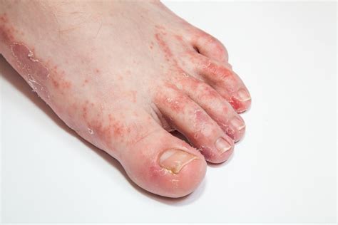 Foot Rash Causes Symptoms Home Remedies And Treatment Pictures
