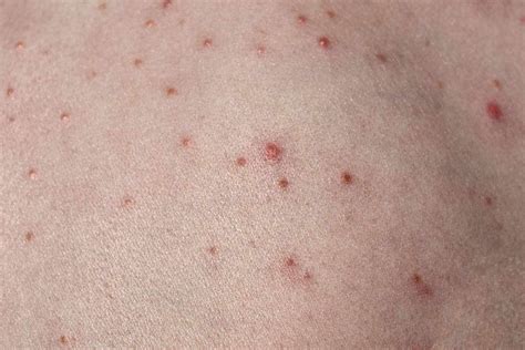 Red Dots On Skin Infection
