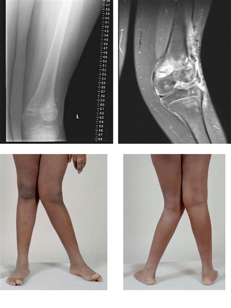 Decreased Ankle Dorsiflexion Is Associated With Dynamic Knee Valgus