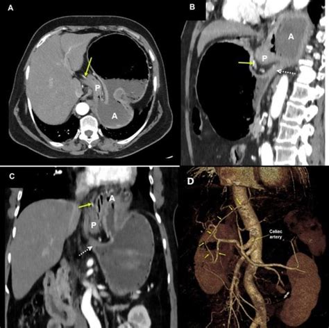 A Axial B Sagittal And C Coronal Ct Angiography Images Show