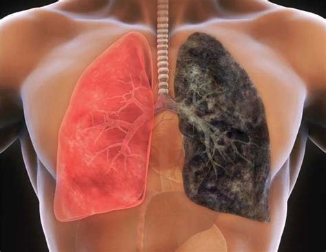Lung Cancer And Non Smokers Lungcancer