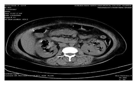 A Ct Kub Showing Bilateral Emphysematous Pyelonephritis Class Iv