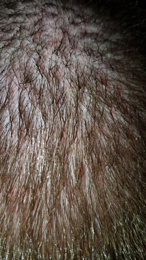 Scalp Acnefolliculitis Pictures General Acne Discussion By