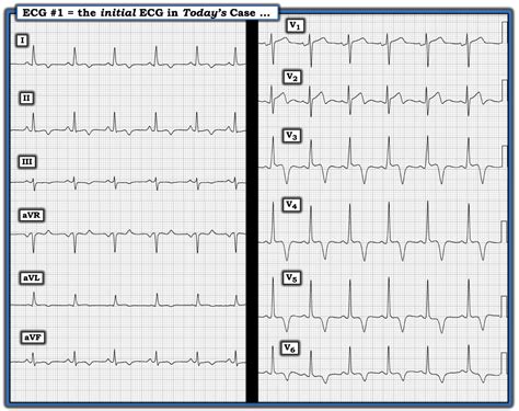 Asymptomatic With Inverted T Waves Relias Media