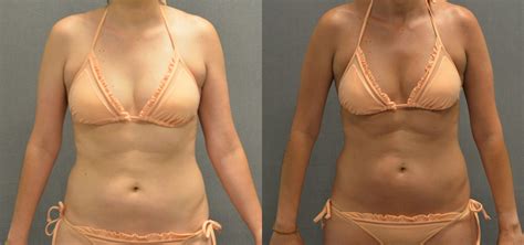 Spray Tan Before After Sabini Premier Spa And Laser Center