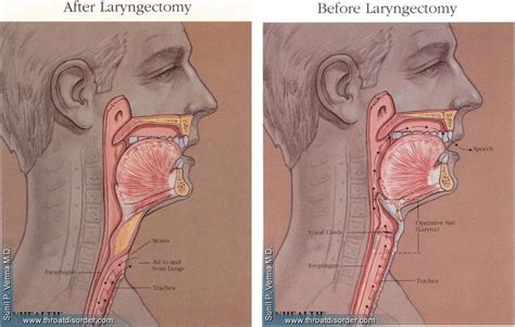 Laryngectomy Southern California Orange County Otolaryngology Ent