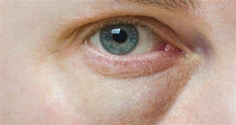 7 causes of puffy swollen eyes