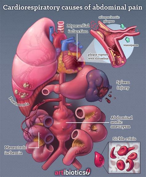 Cardiovascular And Respiratory Causes Of Abdominal Pain