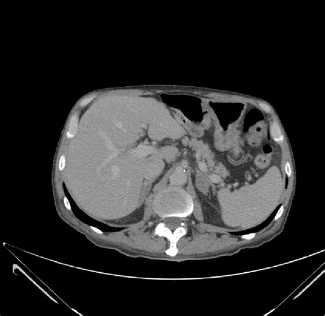 Abdominal Computed Tomography Showing A Normal Image Of The Pancreas