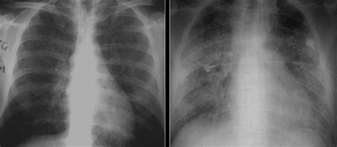 When the cysts have thick walls like in langerhans cell histiocytosis or honeycombing, it frequently presents as a reticular pattern on a cxr. File:X-ray of ground glass opacities of pneumocystis ...