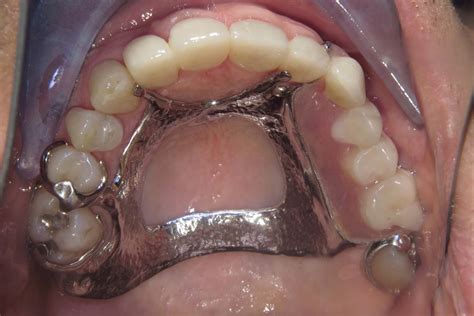 Full Mouth Rehabilitation Smile Gallery Raber Dental Kidron Dentist