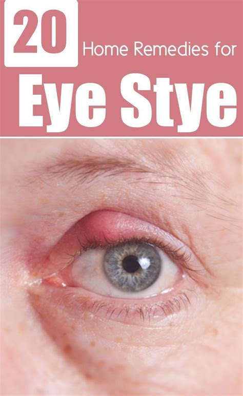 26 Effective Home Remedies To Get Rid Of Eye Stye Health Remedies