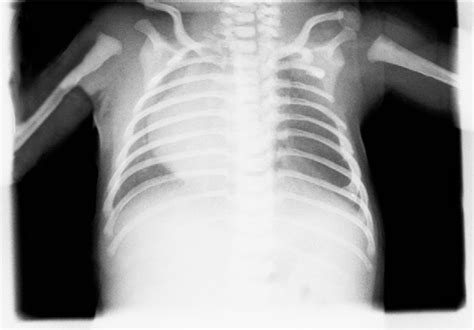 Figure 5 From Thoracic Defects Cleft Sternum And Poland Syndrome