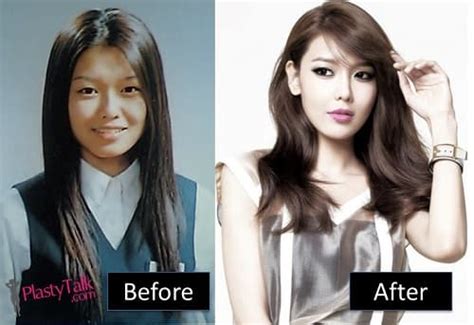 Kpop Idols Plastic Surgery Before And After Celebrity Plastic Surgery