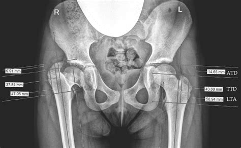 It projects from the lower and back part of the base of the neck. Relative overgrowth of the greater trochanter and ...