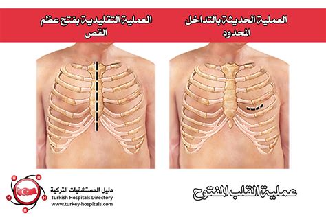 عملية القلب المفتوح