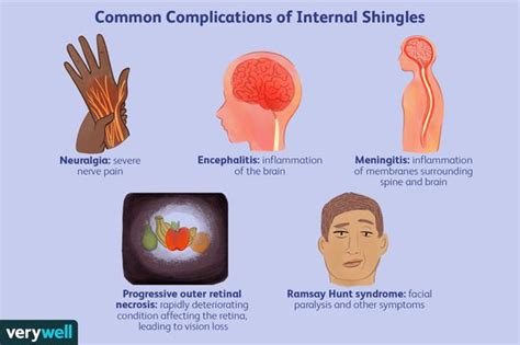 Internal Shingles Risks And Complications