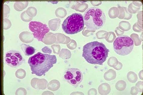 Nucleated Red Blood Cells Nrbc