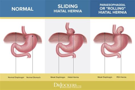 Hiatal Hernia Symptoms Causes And Natural Support Strategies In 2021