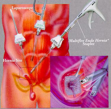 However, some colons can be technically challenging and the procedure may be incomplete. Inguinal Hernia - Colorectal Cancer Surgery