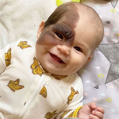 Mom Shares Her Daughters Unique Birthmark Who Drove Instagram Crazy