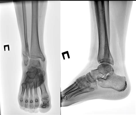 30 Yo Male Patient With Lateral Malleolus Malunion After Download