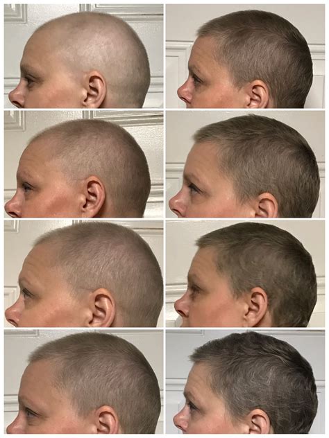 Hairstyles After Chemo Hair Loss Hairstyle Catalog