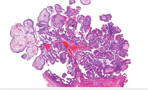 Gallbladder Cholesterol Polyp With Heterotropic Bone Formation A