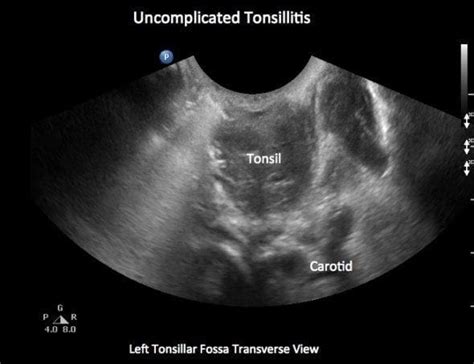 Tonsillar Ultrasound • Litfl • Ultrasound Library