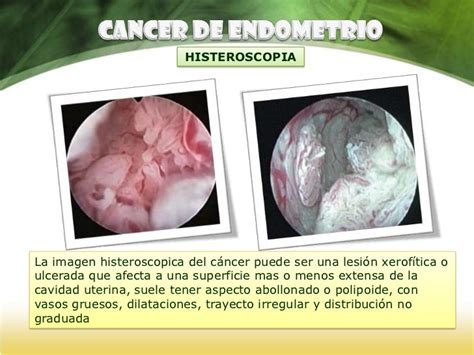 Cancer Endometrial