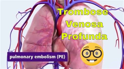 Trombose Venosa Profunda Tvp Causas Sintomas E Tratamentos