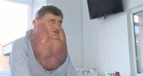 Slovakian Mans 13 Pound Fatty Tumor Removed From Face