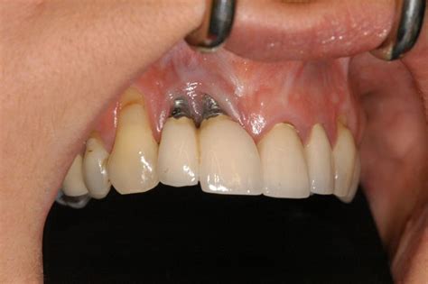 7 Factors That Cause Dental Implant Failure