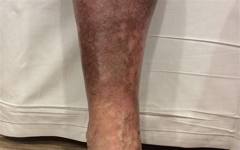 Skin Discoloration On Legs Causes Types Treatments