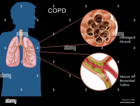Severe Copd Hot Sex Picture