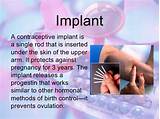 Images of Rod Implant Contraceptive Side Effects