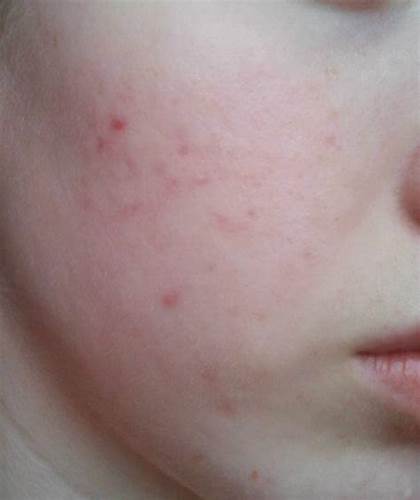 Похудел обвисла кожа на лице