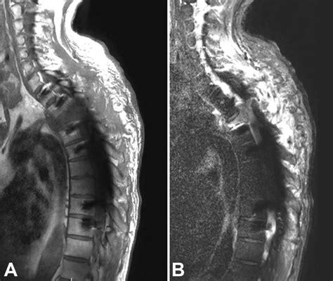 A 75 Year Old Man With T3t6 Spine Metastases And T3 Pathological
